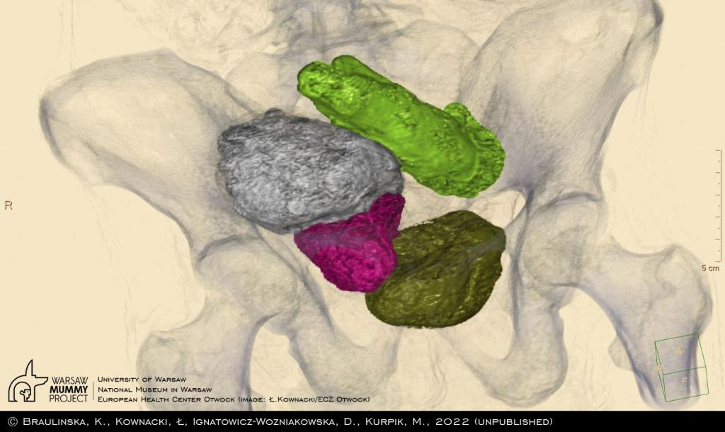 The contents of the mummy's pelvis (front view), as a result of the segmentation of images, showing various types of packages placed by ancient embalmers, which (except for the upper one, which was omitted) were interpreted by the previous authors as the fetus. Image created with an IntelliSpace Portal (Philips) server.  Ł. Kownacki (ECZ Otwock)