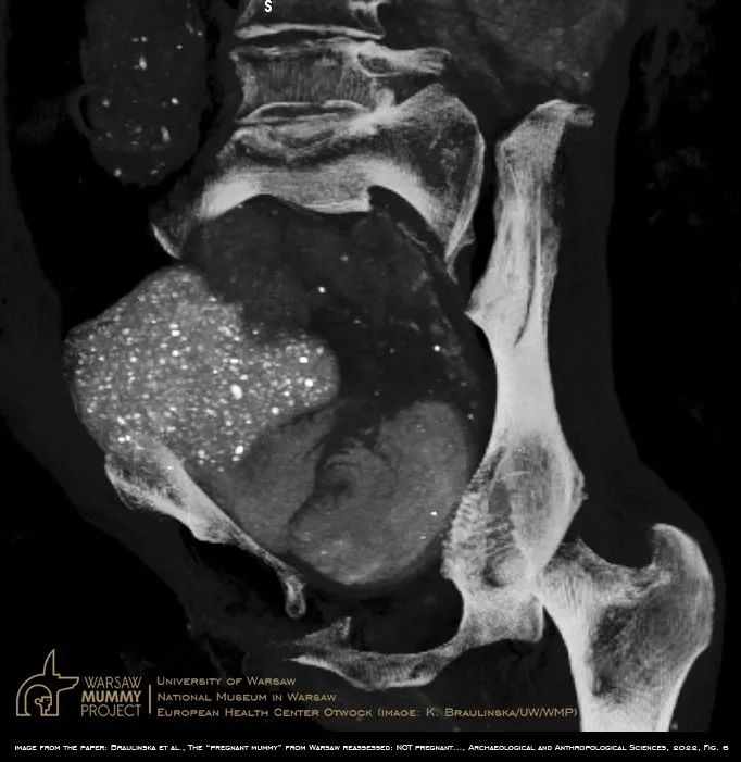 Rekonstrukcja okolicy rzekomej “główki płodu” za pomocą oprogramowania OsiriX MD (Pixmeo). Widoczny efekt “zamieci śnieżnej” wywołany licznymi ziarnistościami wewnątrz największego pakunku. Ziarnistości te mają porównawczo znacznie wyższą gęstość radiologiczną od kości zmumifikowanej kobiety, co łącznie z brakiem typowych dla czaszki struktur anatomicznych, całkowicie wyklucza główkę płodu. K. Braulinska (UW/WMP). Źródło; j.w.