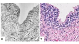 The image of prostate cancer obtained with confocal QPI (b) is qualitatively very similar to the image of the sample obtained when staining the sample (d). The main difference, however, is that in order to image a sample with confocal QPI, it does not need to be modified or destroyed (which is the case with staining). Source: Optica https://doi.org/10.1364/OPTICA.395363