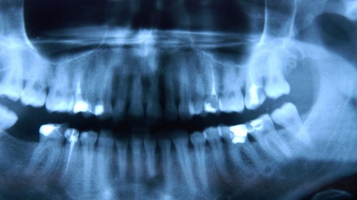 Trzeci komplet zębów zamiast tradycyjnych implantów?  Badają to polscy naukowcy
