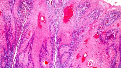 Rak kolczystokomórkowy lub rak płaskonabłonkowy, fot. Adobe Stock