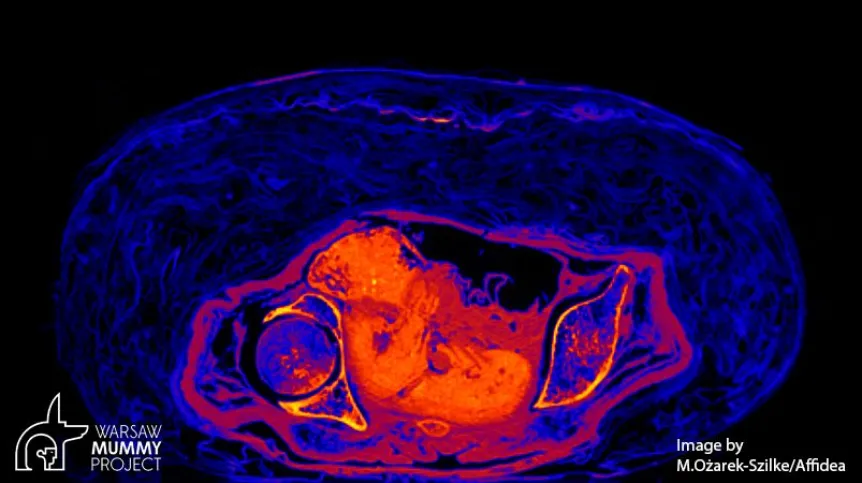 A foetus in a mummy. Credit: M. Ożarek-Szilka/Affidea