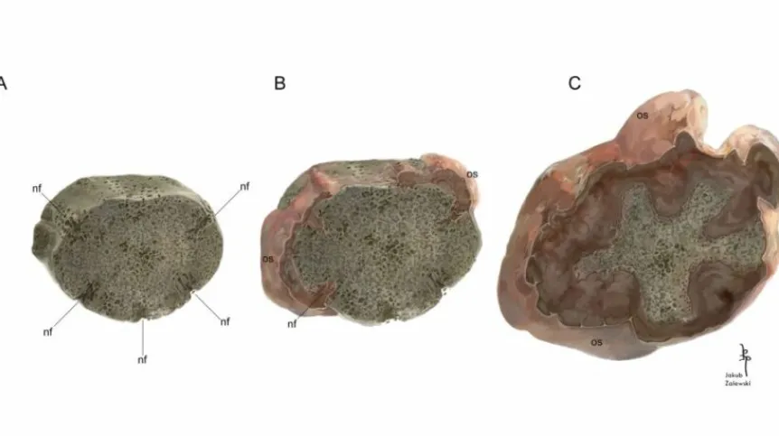 The reconstruction of growth of neoplastic tissue on the vertebral intercentrum ZPAL Ab III/2467 during ontogeny. A: the normal, ontogenetically juvenile intercentrum, with only a thin layer of the periosteal bone on the ventral part of the bone and visible nutrition foramina, nf reaching deep into the endochondral bone; B: the overgrowth of the neoplasm producing osteoid, os, the normal periosteal and neoplasm are deposited at the same time; C: during the growth the faster growing neoplasm gradually limit 