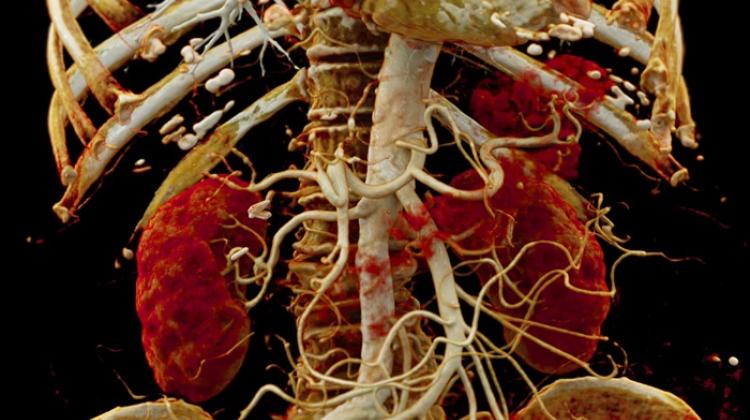 Efekt obrazowania tętnic nerkowych, pozwala zobaczyć naczynia krwionośne zaopatrujące nerki, Adobe Stock