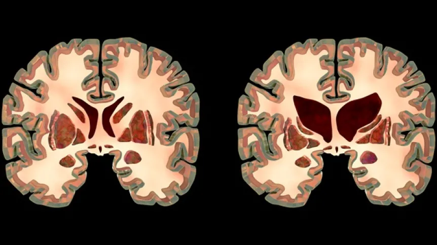 Przekrój mózgu osoby zdrowej i osoby z chorobą Huntingtona, Adobe Stock